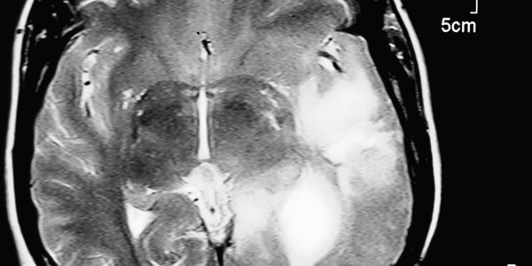 Epigenetic Mechanism Behind The Most Malignant Of All Brain Tumours