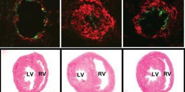 Oxidized Lipids: Protein In HDL May Be Key To Treating Pulmonary Hypertension