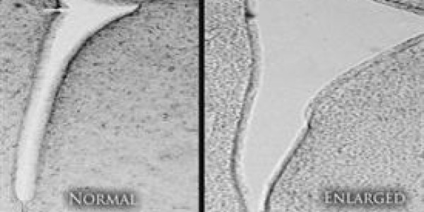 Study Implicates Smog In Autism And Schizophrenia