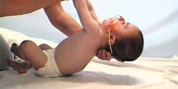 Pompe disease, a rare but important genetic condition