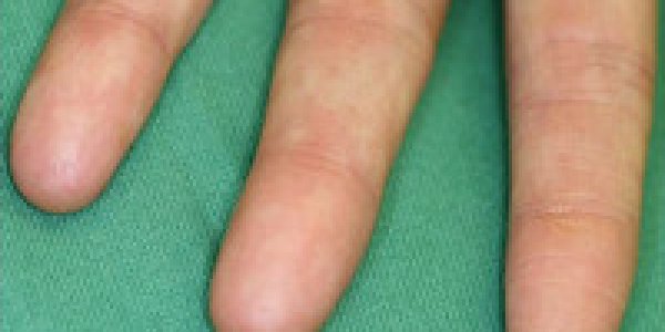 Mutation Erases Fingerprints