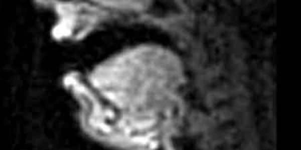 Sopranos - Under MRI