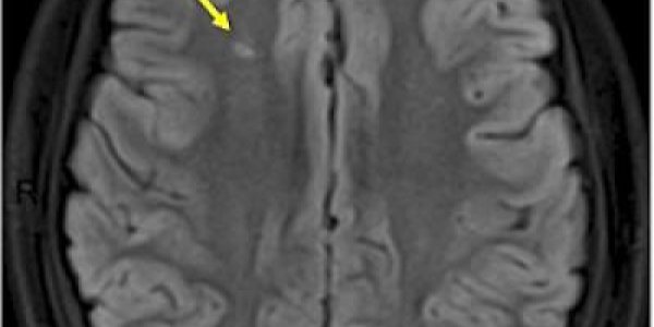 Monthly Transfusions Reduce Silent Strokes In Kids With Sickle Cell Anemia