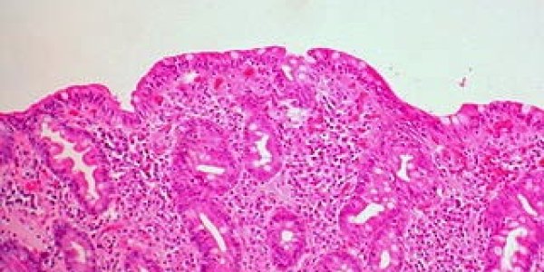 A Fishy Attempt To Link Glyphosate And Celiac Disease