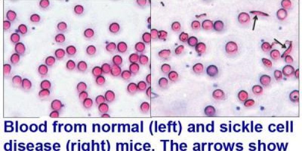 TCP: Old Antidepressant  Could Treat Sickle Cell Disease