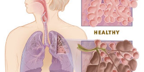 COPD Linked To Cognitive Decline In Aging