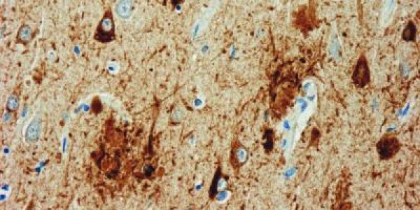 Amyloid-Beta 42 Gene Variation Linked To Early Alzheimer's Symptoms