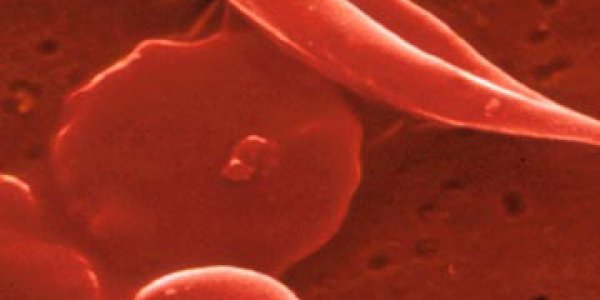 Gene Therapy Cures Sickle Cell In Mice