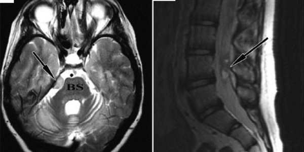 Case Study - Brain And Spinal Tumor Following Stem Cell Therapy