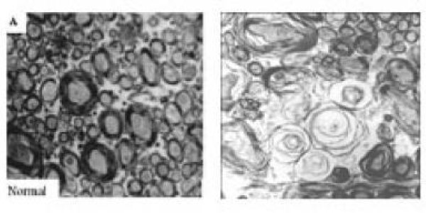 Antidepressant Study In Mothers May Show Autism Link In Offspring