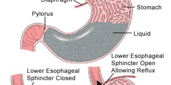 Faulty Sphincter?  GERD Yourself For A Magnetic Solution