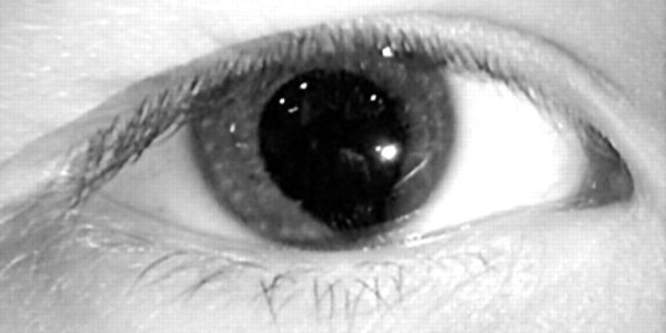 Coloboma: Humans with "Cat Eyes"