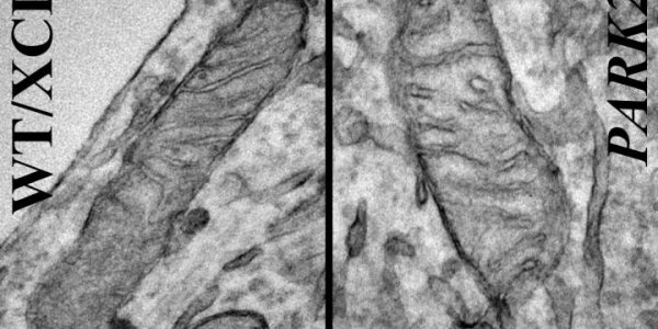 Mitochondria Mutation Linked To Human Parkinson's Disease For First Time