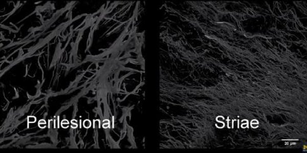 What Happens To Your Skin When Pregnancy Gives You A Stretch Mark