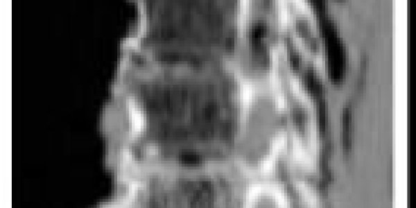 Amenhotep III: Ancient Egyptian Mummies Didn't Have Spinal Arthritis