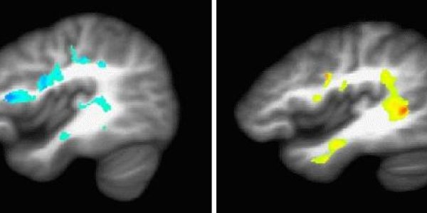 Heavy Marijuana Use May Damage Developing Brain In Teens And Young Adults