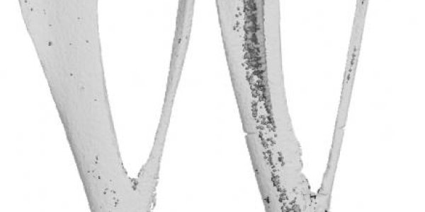 Bone Marrow Fat Helps The Body Stay Healthy