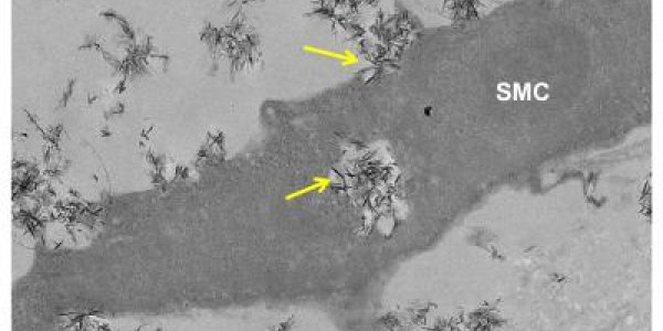 Protective Proteins Reduce Damage To Blood Vessels