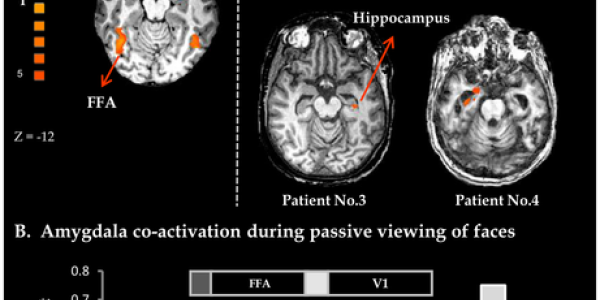 Brains Of Patients In A Vegetative State React To Photographs Of People They Know