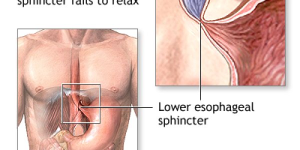 Achalasia Esophagus Disease Is Autoimmune