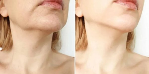 Move Over Ozempic. FDA Has Approved A New Weight Loss Injection Celebrities Will Exploit