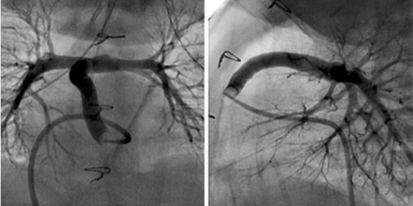 A Reinforced Cylinder Leads To Fewer Repeat Surgeries For Children Born With Hypoplastic Left Heart Syndrome
