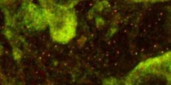 Fragile X Granule Could Lead To New Autism Treatment