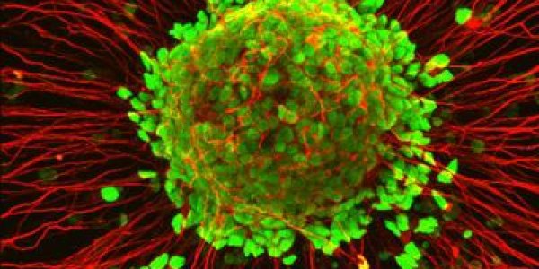 Study Helps Unravel The Tangled Origin Of Lou Gehrig's Disease