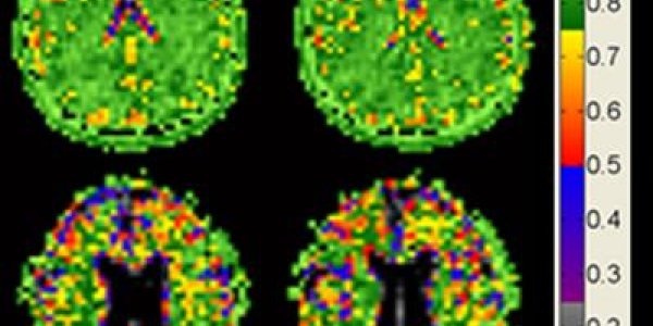 Cell Density Remains Constant As Brain Shrinks With Age