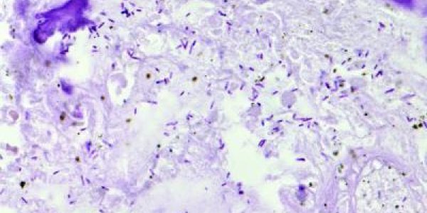 Injected C. Noyvi-NT Bacteria Shrink Tumors In Rats, Dogs - And Humans