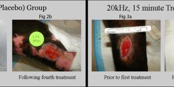 Clinical Trial: Ultrasound Band-Aid Heals Venous Ulcers