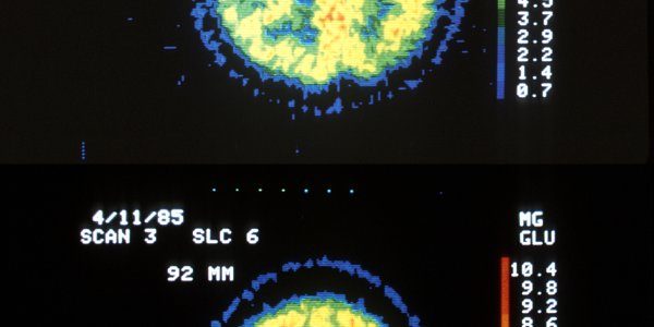 Cancer Initiating Stem Cells Suppress Immune Response To Brain Tumor And The Role Of STAT3 Pathway In Immunosuppression