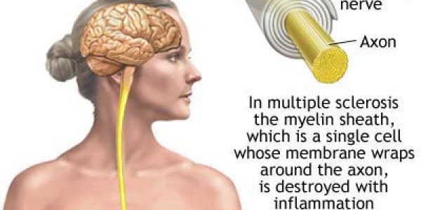 Study Proves Advances in Treatment for Multiple Sclerosis