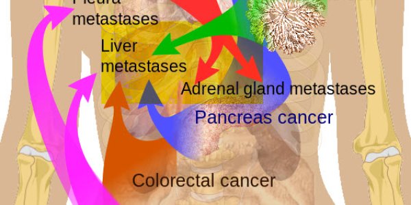 Metastasis: Broken Cellular Function Mechanism Observed In Mice
