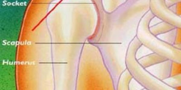 Healing a shoulder separation