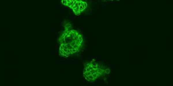 A New Approach For Bowel Cancer