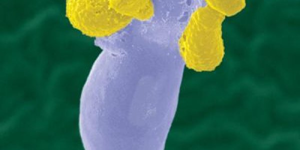 13 Year Old Finds Fungus Deadly To AIDS Patients