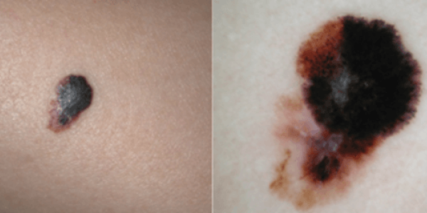 18% Fewer Deaths Since 2013: Melanoma Treatment Has Been A Huge Public Health Victory