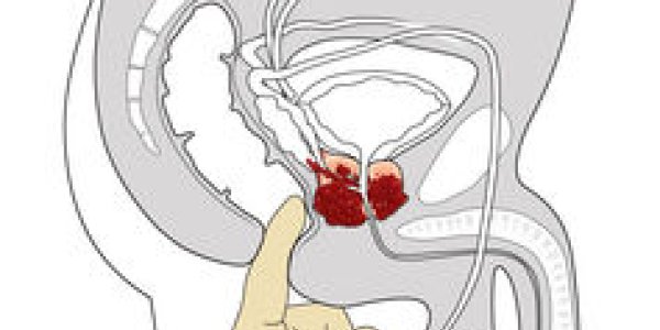 No Digit: Rectal Exams Aren't The Best Way To Find Prostate Cancer