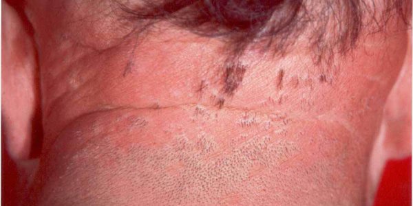 Lassueur Piccardi Graham Little Syndrome