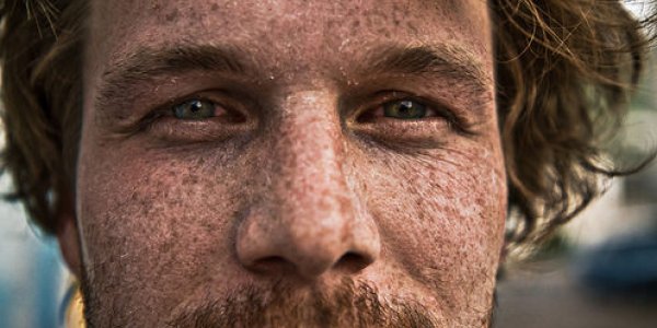 Is That A Harmless Mole Or Potential Skin Cancer?