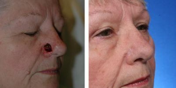 One-Step Nose Repair After Skin Cancer
