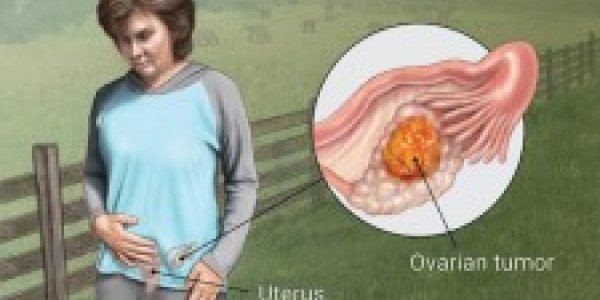 Ovarian Cancer: Why Dont More Doctors Use This Life-Extending Technique?