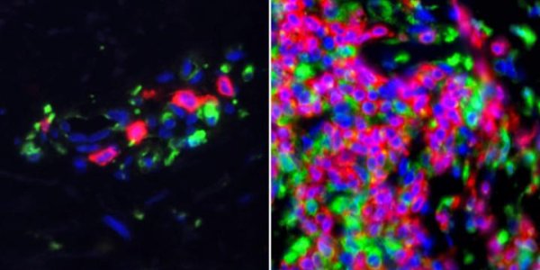 Sometimes It Is Lupus - And Here Is What Cancer Scientists Just Discovered