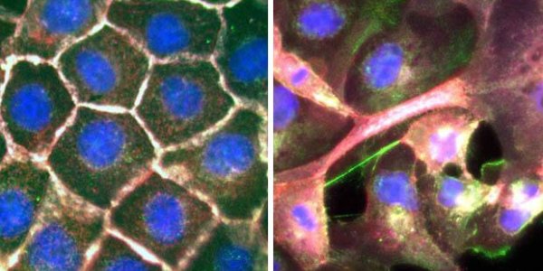 TIAM1 Breakdown - How Lung Cancer Spreads