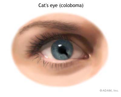 Coloboma with a more defined 