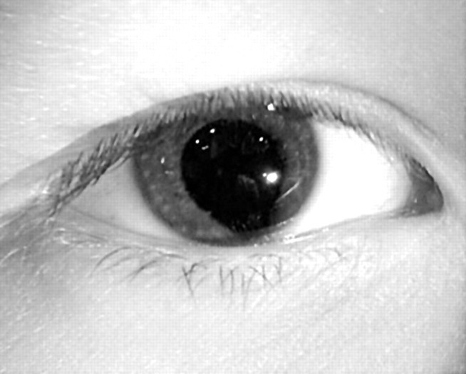 Coloboma