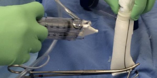 How To Implant An Artificial Heart - Instructions