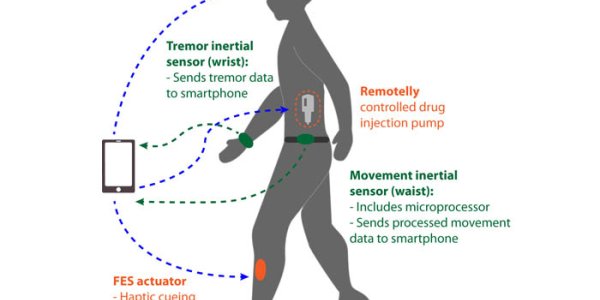 REMPARK: Wearable System Treats Parkinson’s Patients In Real Time