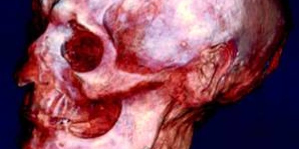 Next generation forensics - the virtual autopsy